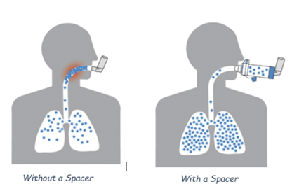 A diagram of a person's lungs showing that more medicine reaches the lungs using an inhaler with a spacer than without a spacer.