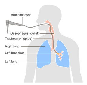 Image Image of human upper torso and head showing bronchoscope entering through the mouth, passing through the windpipe and bronchus to the lung. .png