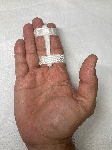 A hand with the index and middle fingers strapped together with gauze between them