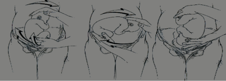 Image of a fetus being gradually turned to secure the cephalic presentation in fetuses with breech presentation.